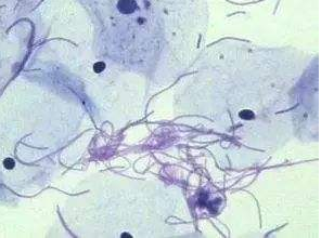 阴道分泌物羞羞视频在线免费看厂家探讨白带清洁度3代表什么意思